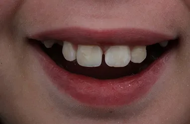 After Anterior Composite