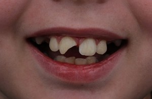 Before dental crowns