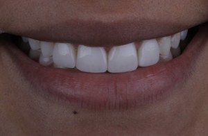 After Composite Veneers