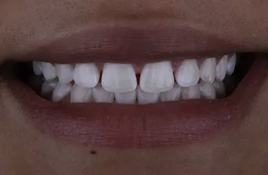 Before Composite Veneers