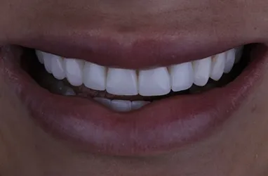 After composite veneers treatment, showing beautiful teeth.