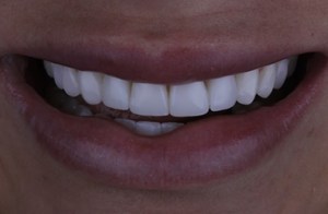 After composite veneers treatment, showing beautiful teeth.