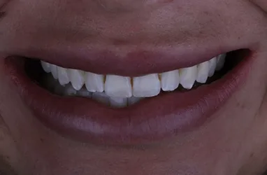 Before composite veneers treatment, showing natural teeth.