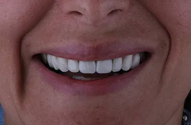 Before Full Mouth Reconstruction