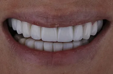 After Full Mouth Reconstruction