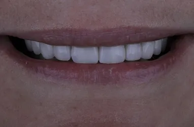 After Porcelain Crowns