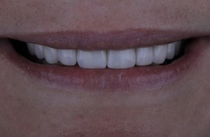 After Porcelain Crowns 