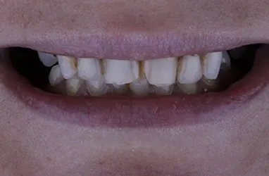 Before Porcelain Crowns