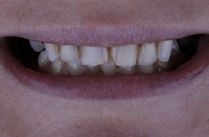 Before Porcelain Crowns 