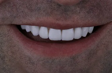 After Porcelain Veneers