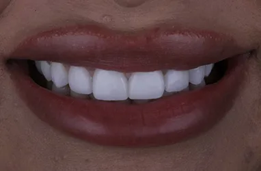 Smile improvement: after porcelain veneers.