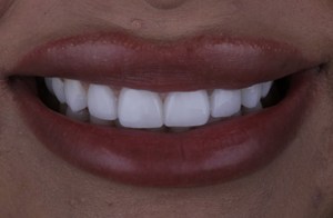 Smile improvement: after porcelain veneers.