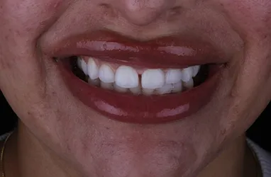 Smile improvement: before porcelain veneers.