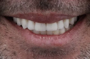 Teeth after receiving composite veneers.