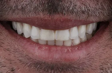 Teeth before receiving composite veneers.