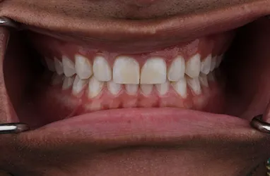 after Teeth Whitening