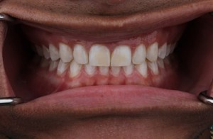 after Teeth Whitening 