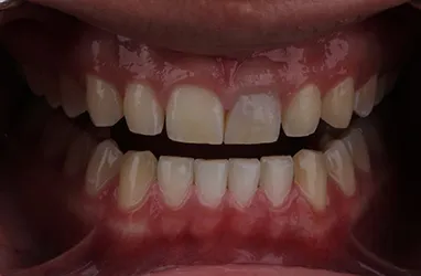 before Teeth Whitening