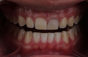 before Teeth Whitening 