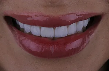 Before porcelain veneers procedure