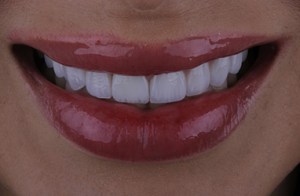 Before porcelain veneers procedure