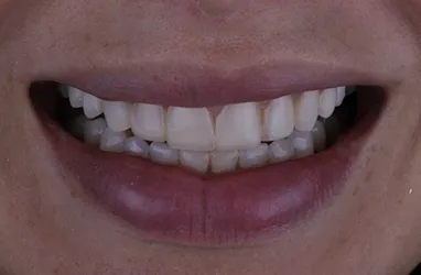 Before porcelain veneers procedure