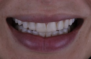 Before porcelain veneers procedure